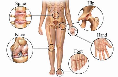 osteoarthritis-vs-rheumatoid-arthritis